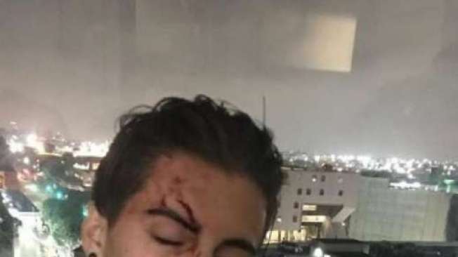 Biel exibe corte na sobrancelha ap�s ser atingido por um copo de vidro