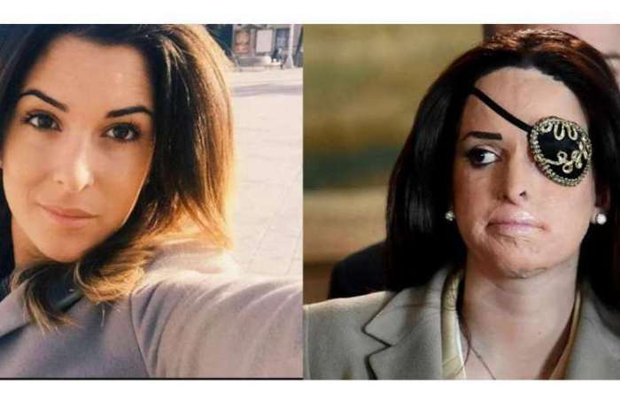 A italiana Gessica Notaro, 29 anos, antes e depois de ser atacada com ácido pelo ex-namorado