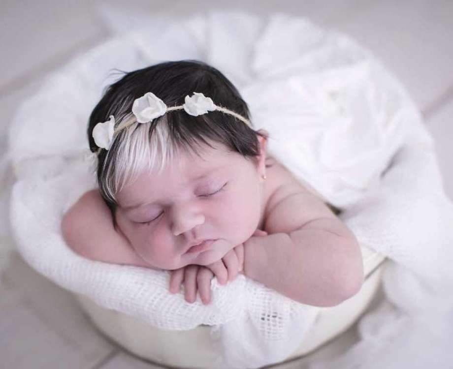 A beb&ecirc; tem uma doen&ccedil;a rara chamada piebaldismo