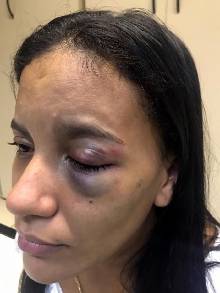 Tamires foi agredida com vários socos na região do olho