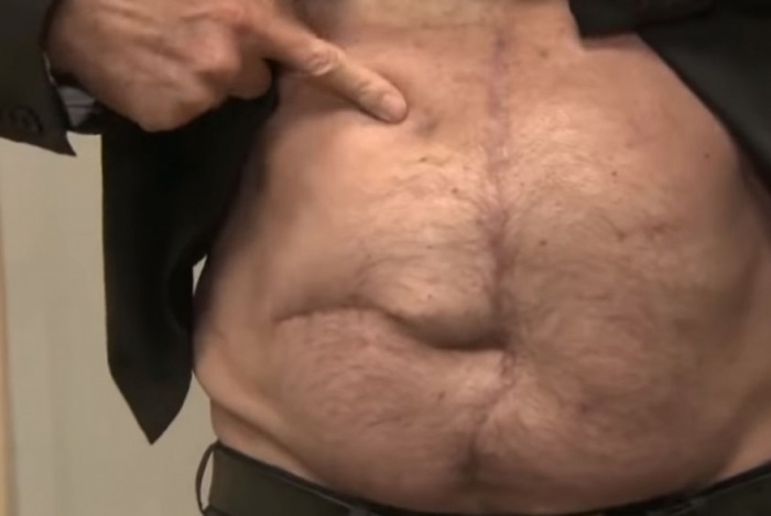 Bolsonaro mostra as cicatrizes que tem na barriga