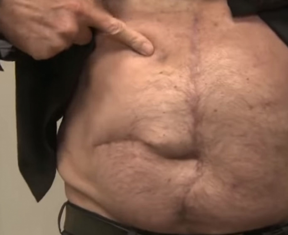 Bolsonaro mostra as cicatrizes que tem na barriga