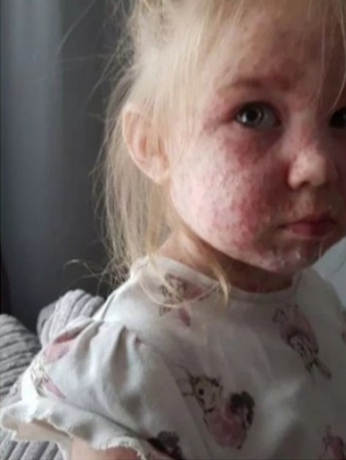 As fotos foram compartilhadas pela mãe da menina, de quatro anos, após ela ficar cheia de manchas e bolhas na pele
