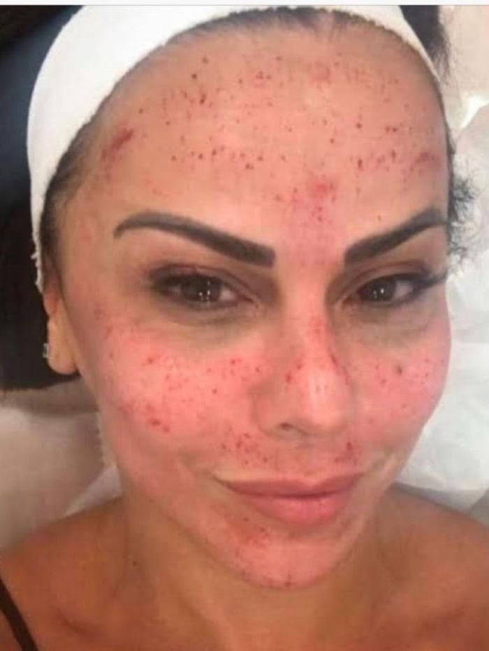 Viviane Araújo está entre as famosas que se submeteram a técnica do microagulhamento 