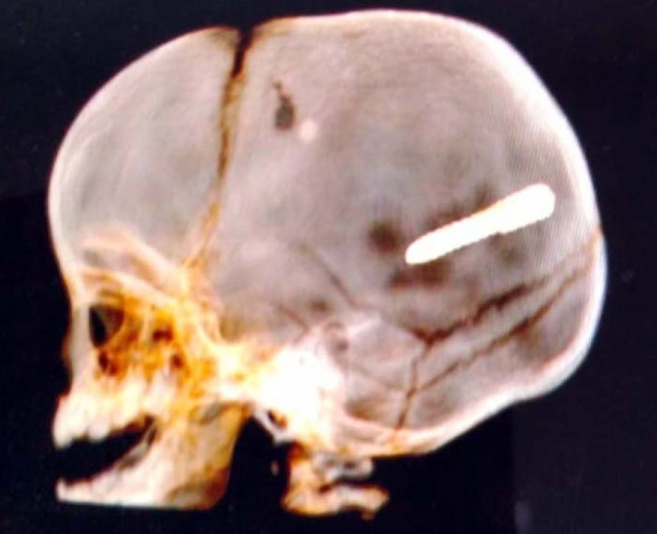 Exame de imagem constatou objeto alojado na cabeça do bebê
