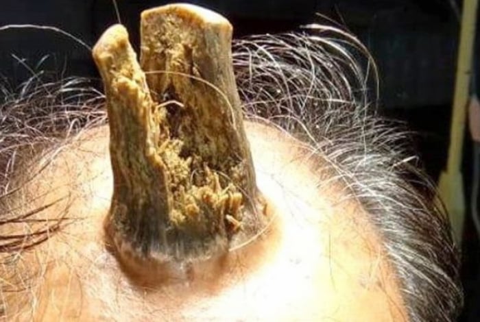  Homem faz cirurgia para retirar chifre