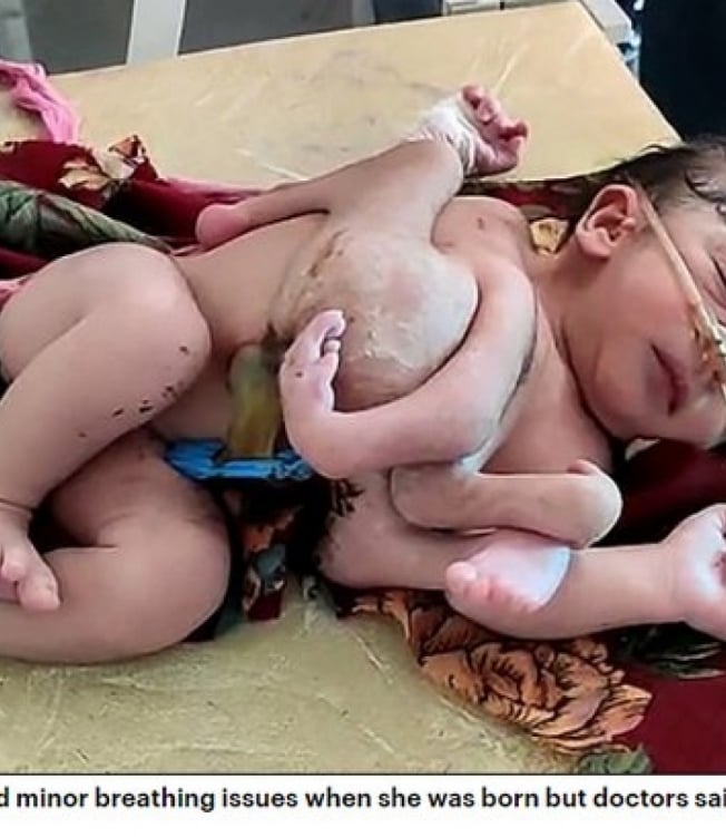 Bebê nasce com três mãos e quatro pernas - Reprodução