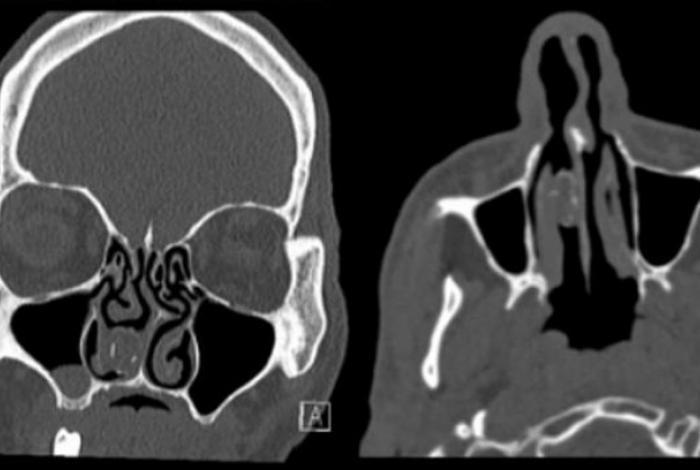 Ressonância magnética detectou maconha escondida no nariz de homem
