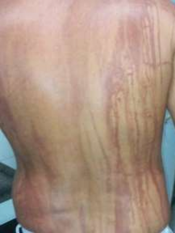 Turista mineiro fica com mancha no corpo ap&oacute;s entrar no mar da Bahia