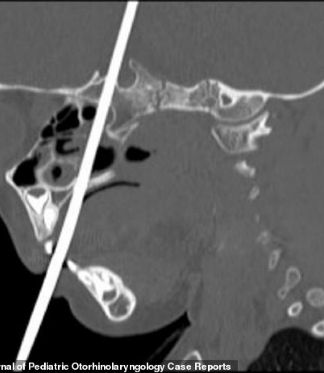 Criança de 3 anos sobrevive após agulha de tricô perfurar seu cérebro - Reprodução / International Journal of Pediatric Otorhinolaryngology