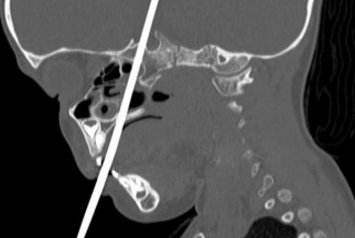 Criança de 3 anos sobrevive após agulha de tricô perfurar seu cérebro
