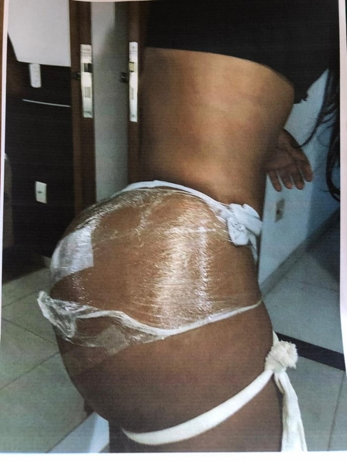 Bumbum após aplicação de silicone industrial