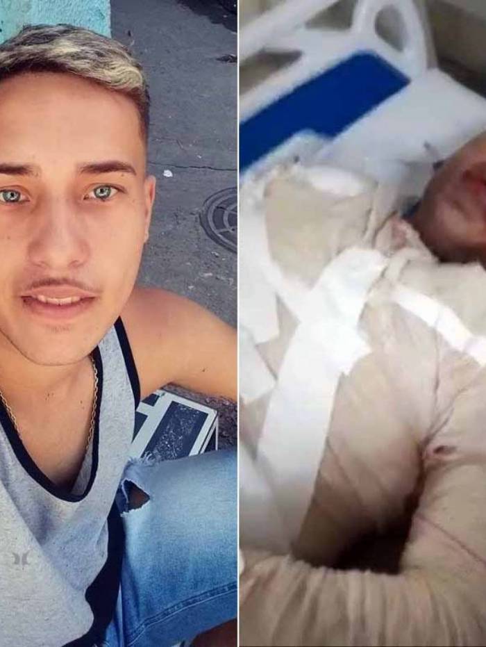 Daniel Jean teve 60% do corpo queimado