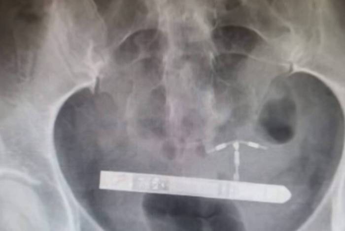 Mulher precisa ser operada após vibrador parar na bexiga