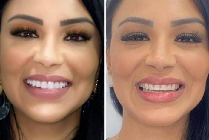 Filha de Gretchen aparece com dentes novos para o Carnaval