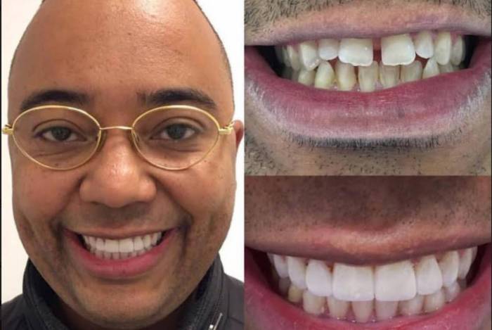 Dudu Nobre entra na onda dos dentes brancos