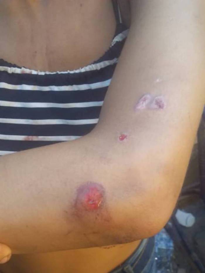 A adolescente sofreu ferimentos por todo o corpo durante agressões