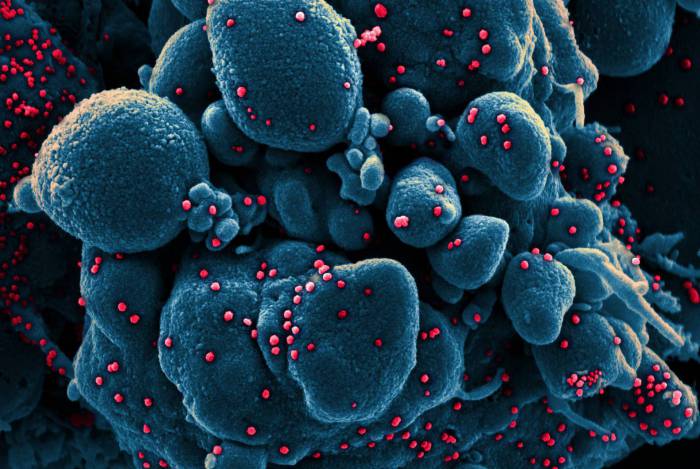 Fotos feitas com microscópico e coloridas digitalmente mostram células do paciente sendo atacadas pelo coronavírus