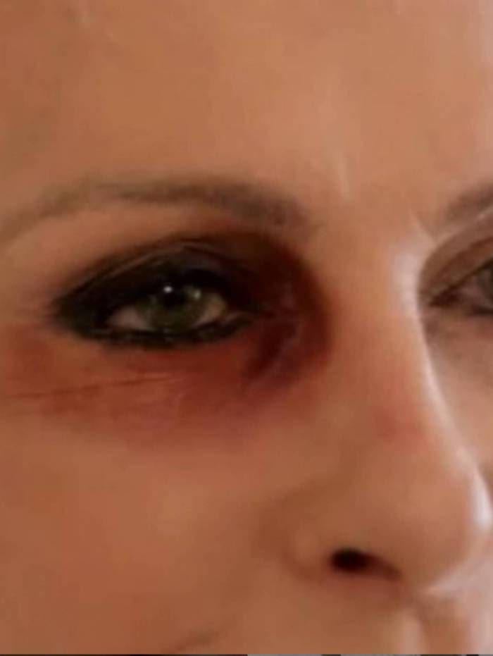 Ana Maria Braga surge de olho roxo