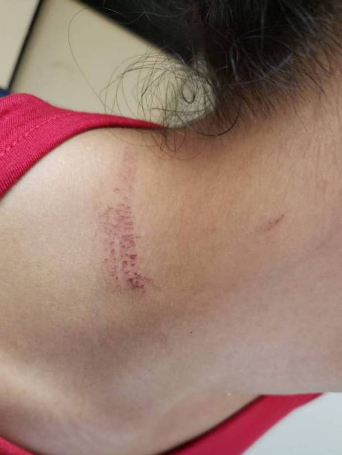 Marca da agressão na vítima