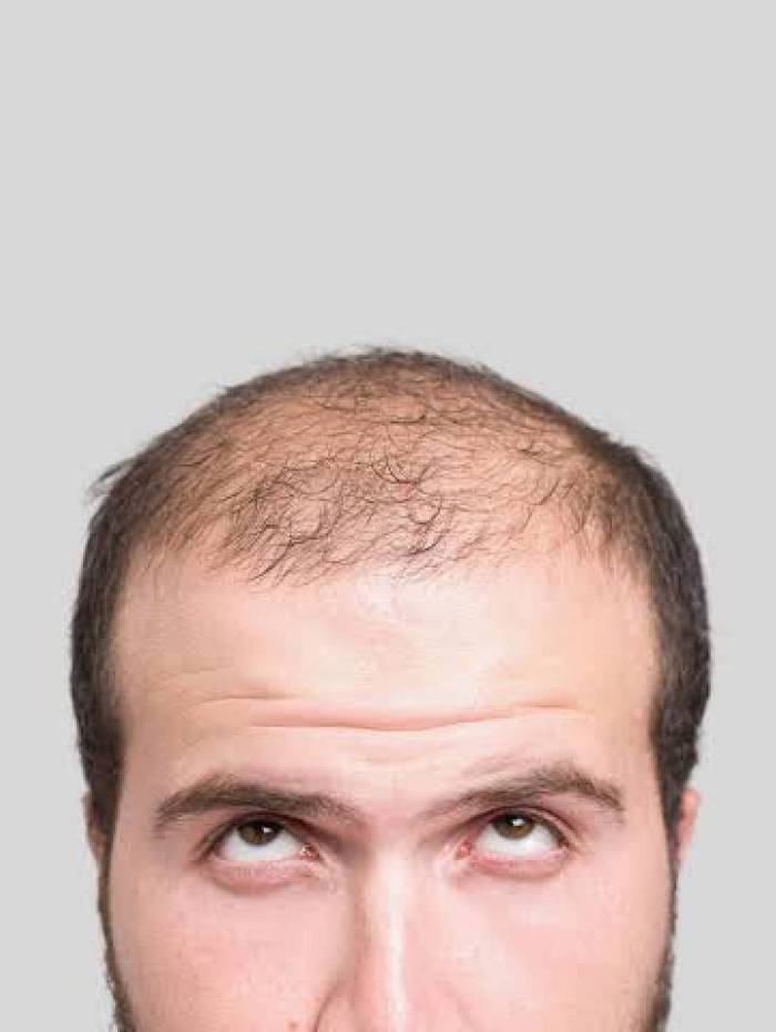 Tricologista conta como identificar os primeiros sinais de calv&iacute;cie e quando buscar tratamento