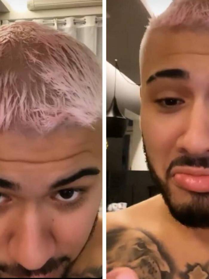 Kevinho tenta descolorir cabelo em casa e fica com buraco no couro cabeludo