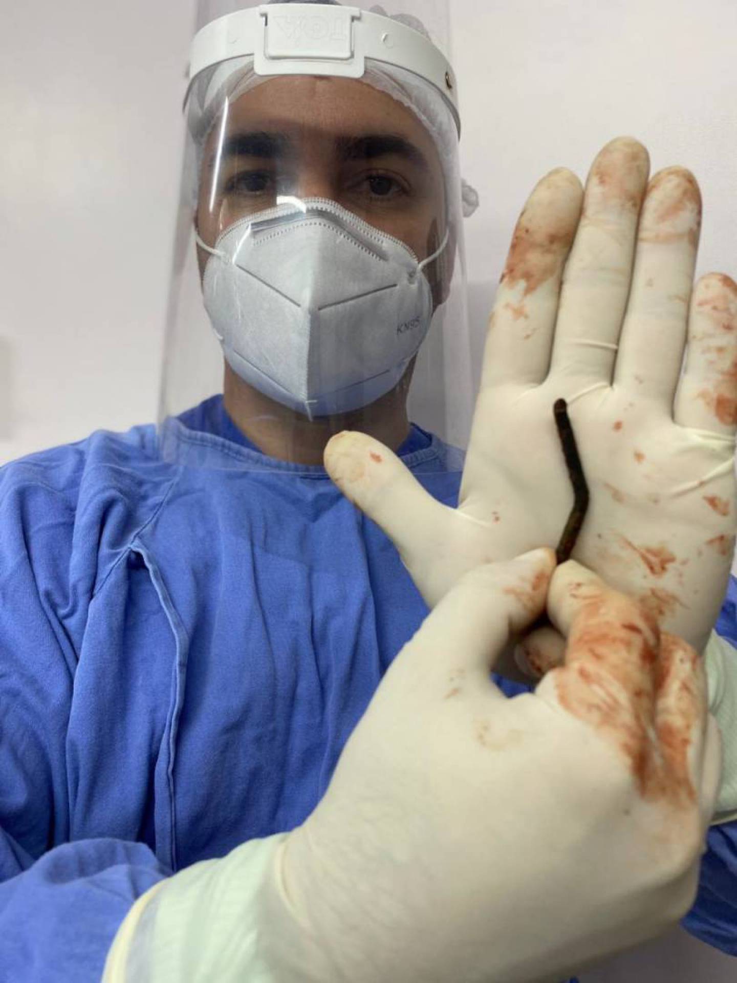 Bruno Chagas mostra o prego retirado do rosto do paciente