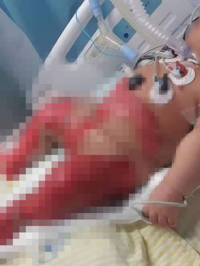 Juliana de apenas seis meses sofreu queimaduras enquanto estava internada no Hospital Municipal Getúlio Vargas, o Getulinho, em Niterói