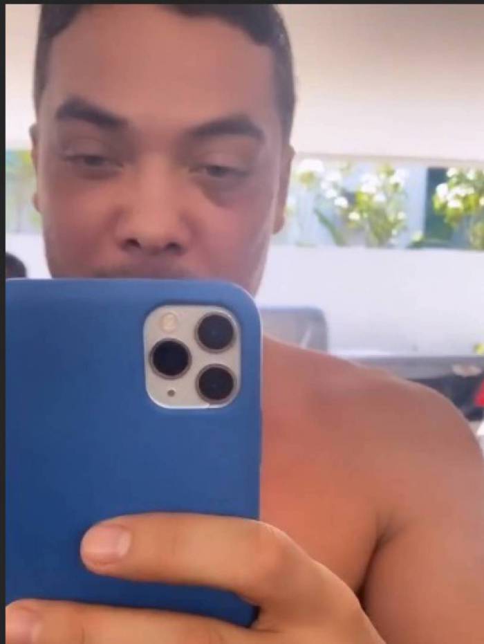 Wesley Safadão mostra o olho roxo