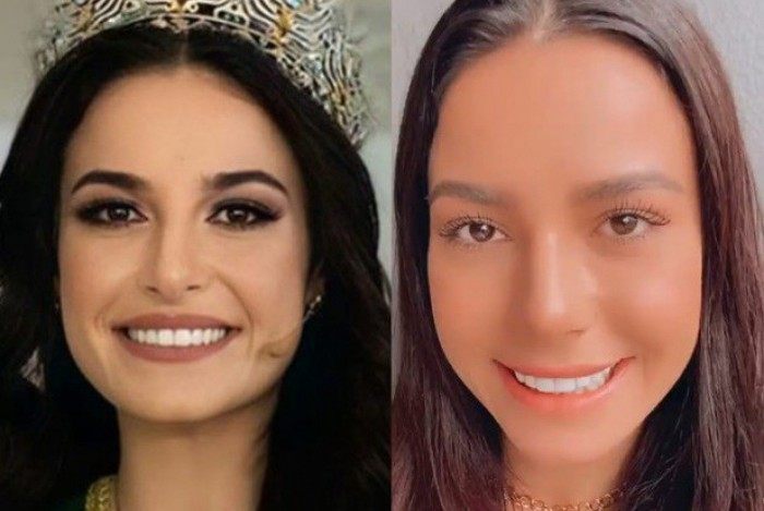 Miss Brasil 2020, Julia Gama faz procedimento no nariz
