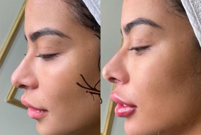 Rafaella Santos passa por procedimentos estéticos e mostra antes e depois