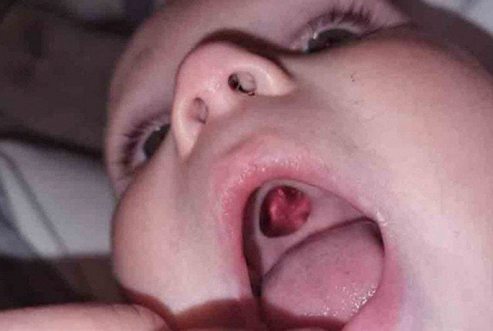 A mãe ficou desesperada ao encontrar "buraco" na boca do bebê.
