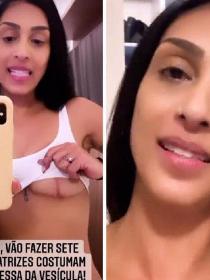 Ex-BBB Amanda mostra as cicatrizes ap&oacute;s retirada de pr&oacute;tese de silicone