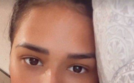 Após fazer cirurgia plástica, Simone dá detalhes sobre seu pós-operatório