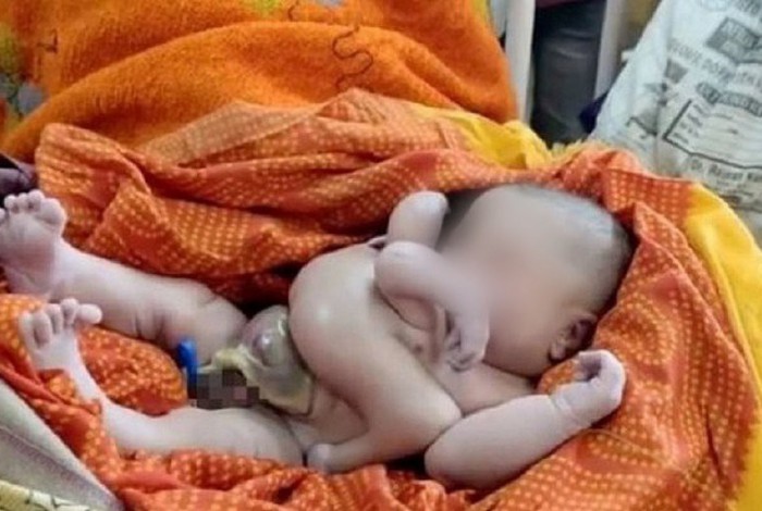 Bebê nasce com quatro braços e quatro pernas na Índia
