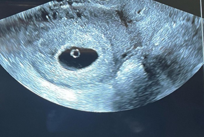 Ultrassom do segundo filho de Virgínia