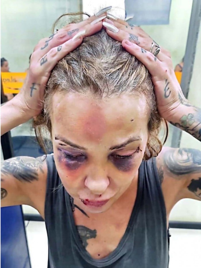 A vítima sofreu traumatismo craniano e fratura na mandíbula