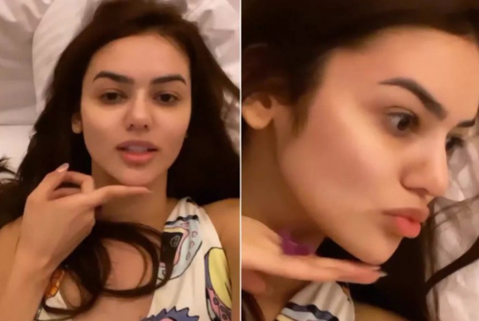 Eslovênia mostra como está seu rosto após passar por harmonização facial