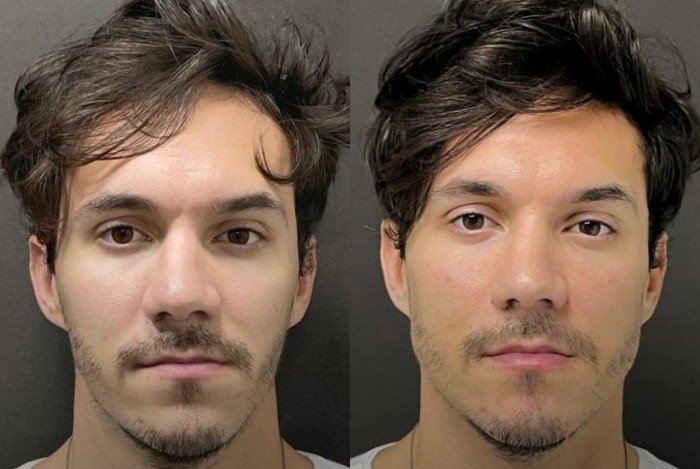 Eliezer mostra resultado de retoque da harmonização facial