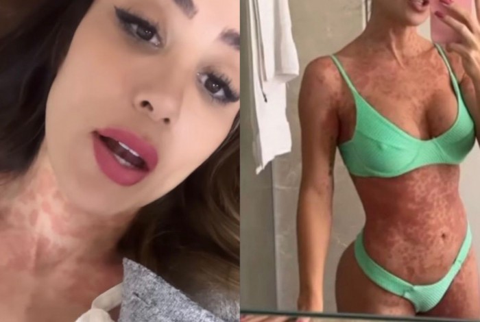 Com diversas manchas no corpo, Letícia Santiago revelou que ainda não sabe a causa da inflamação na pele