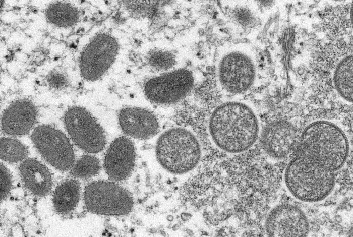 Brasil investiga seis casos suspeitos de varíola do macaco