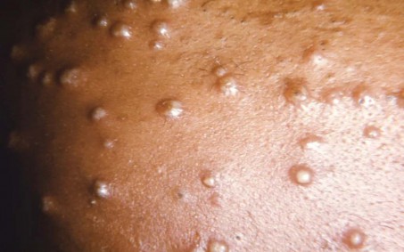 Rio registra 71 casos ativos da varíola dos macacos