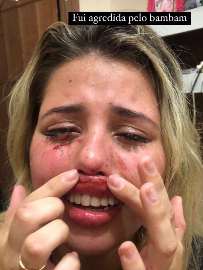 A influenciadora publicou uma s&eacute;rie de v&iacute;deos em que mostra o rosto machucado devido as agress&otilde;es sofridas pelo namorado