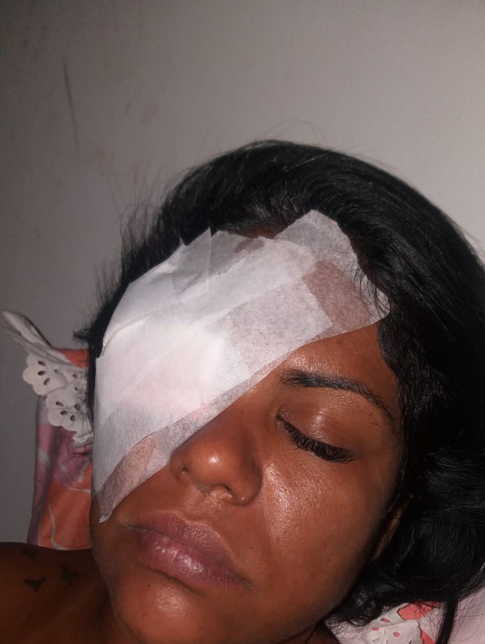 Bruna teve les&atilde;o profunda na t&ecirc;mpora direita e fratura do osso, al&eacute;m de ferimentos na c&oacute;rnea