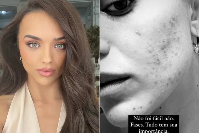 Rafa Kalimann mostra rosto com acne e fala sobre baixa autoestima