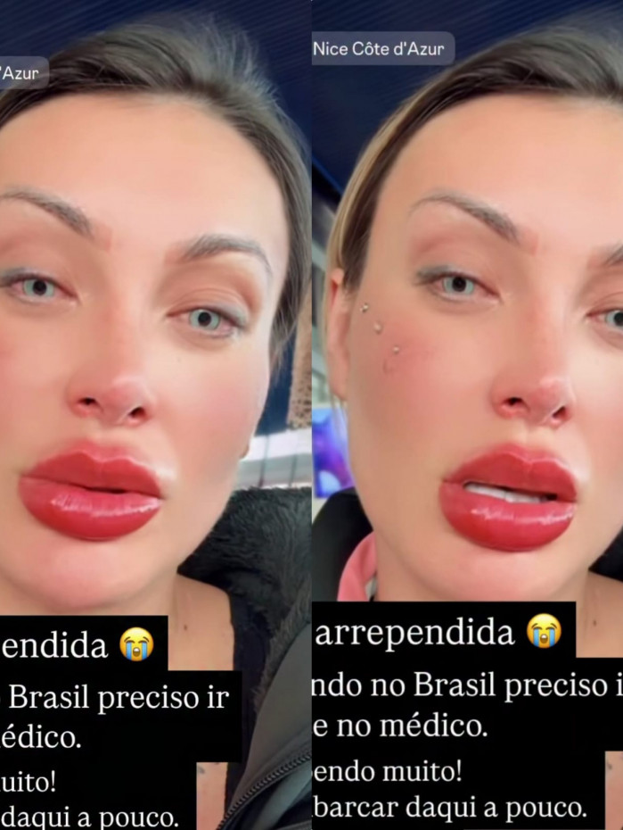Andressa Urach se arrepende de cirurgia que clareou olhos: 'Muita&nbsp;dor'
