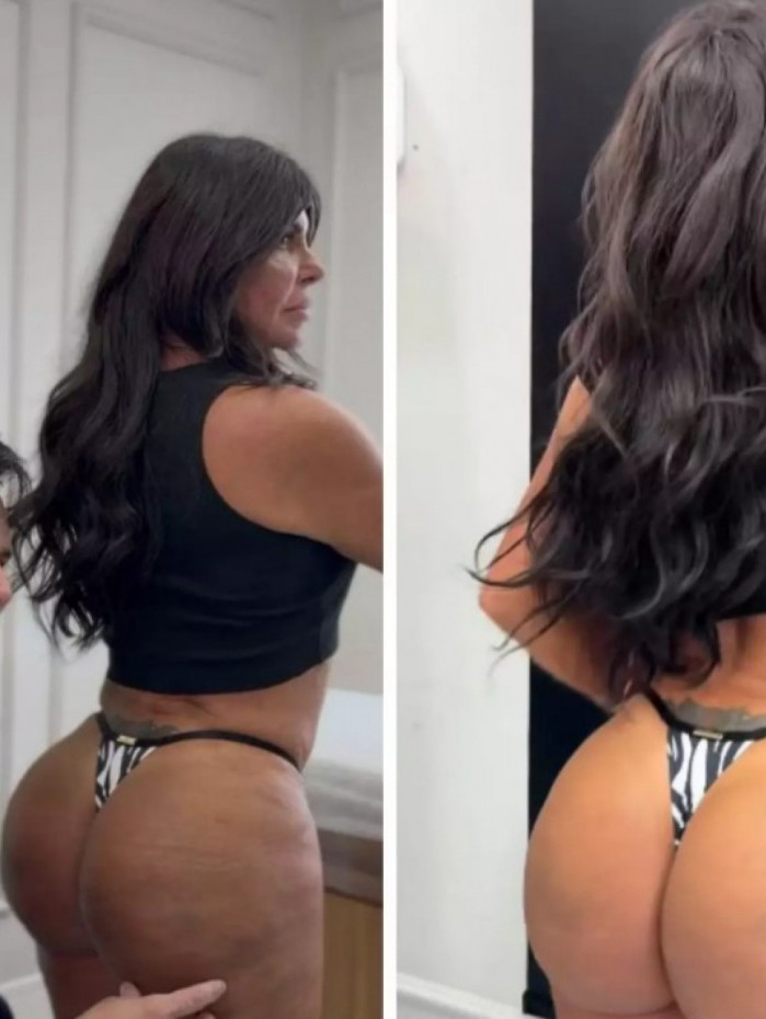Gretchen faz harmonização no bumbum e mostra resultado