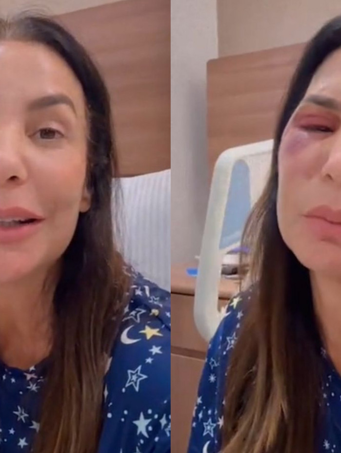 Ivete Sangalo revela que quebrou dois ossos do rosto e precisou de cirurgia