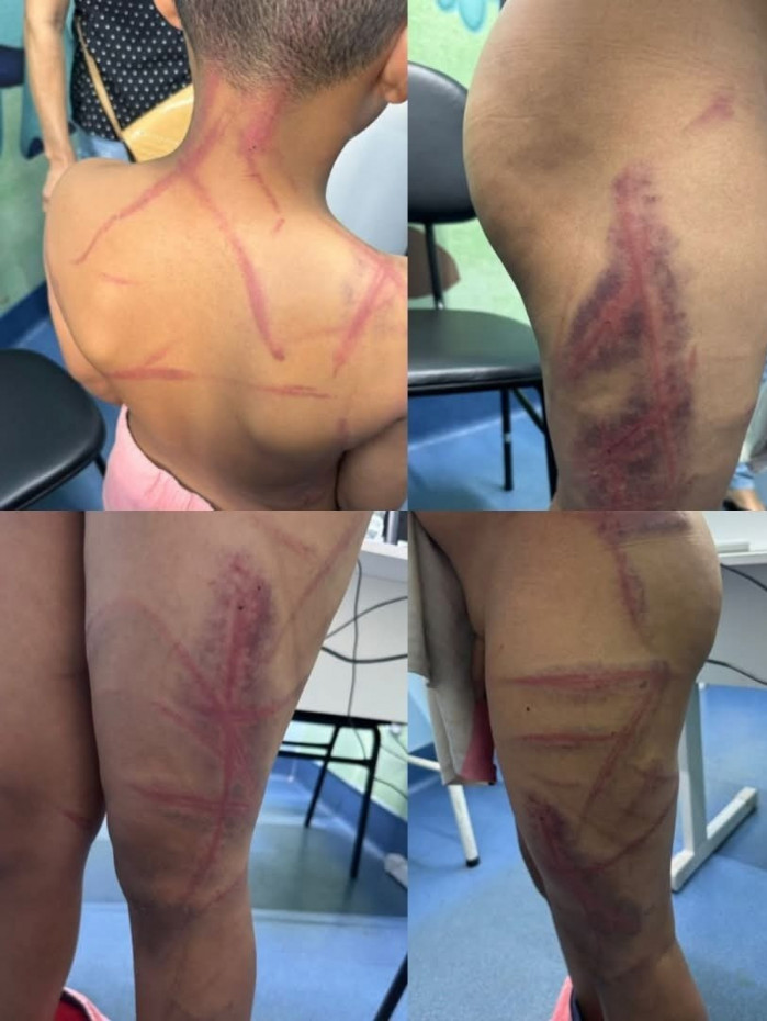 Crian&ccedil;a ficou com diversos hematomas pelo corpo