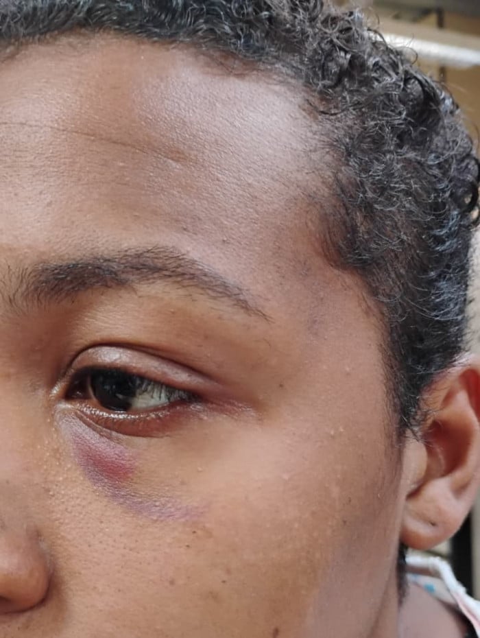 A v&iacute;tima teve o cabelo cortado, foi mordida e agredida diversas vezes